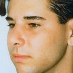 Chin and Cheek Implants Before & After Patient #1981