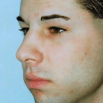 Chin and Cheek Implants Before & After Patient #1981