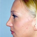Chin and Cheek Implants Before & After Patient #1980