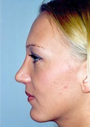 Chin and Cheek Implants Before & After Patient #1980