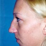 Chin and Cheek Implants Before & After Patient #1980