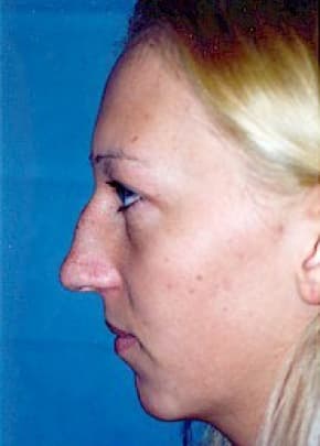 Chin and Cheek Implants Before & After Patient #1980