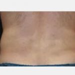 CoolSculpting Before & After Patient #2148