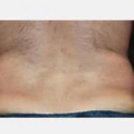 CoolSculpting Before & After Patient #2148