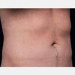 CoolSculpting Before & After Patient #2147