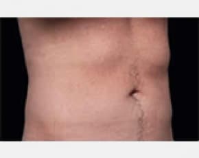 CoolSculpting Before & After Patient #2147