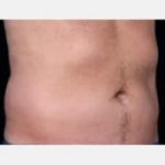 CoolSculpting Before & After Patient #2147