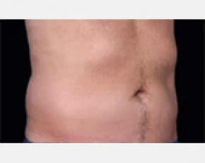 CoolSculpting Before & After Patient #2147