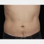 CoolSculpting Before & After Patient #2146