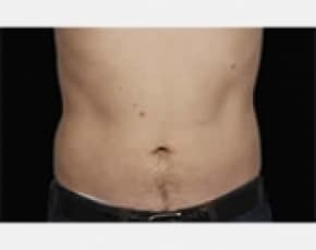 CoolSculpting Before & After Patient #2146