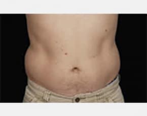 CoolSculpting Before & After Patient #2146