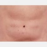 CoolSculpting Before & After Patient #2145