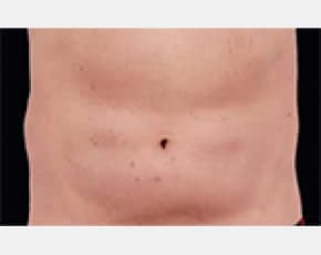 CoolSculpting Before & After Patient #2145
