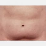 CoolSculpting Before & After Patient #2145