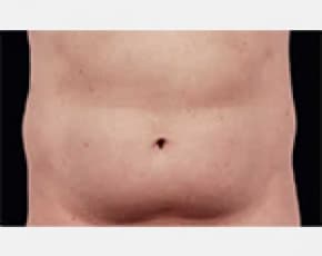 CoolSculpting Before & After Patient #2145