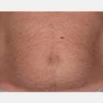 CoolSculpting Before & After Patient #2144