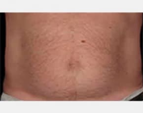 CoolSculpting Before & After Patient #2144