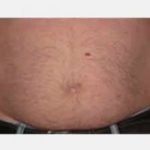 CoolSculpting Before & After Patient #2144