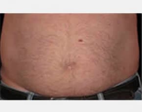 CoolSculpting Before & After Patient #2144