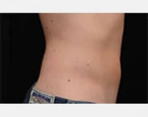 CoolSculpting Before & After Patient #2143