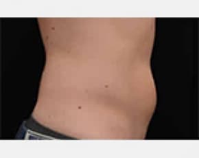 CoolSculpting Before & After Patient #2143