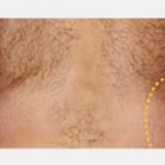 CoolSculpting Before & After Patient #2142