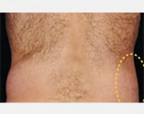 CoolSculpting Before & After Patient #2142