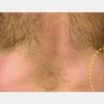 CoolSculpting Before & After Patient #2142