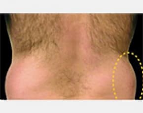 CoolSculpting Before & After Patient #2142