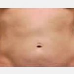 CoolSculpting Before & After Patient #2141