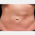 CoolSculpting Before & After Patient #2140