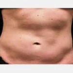 CoolSculpting Before & After Patient #2140