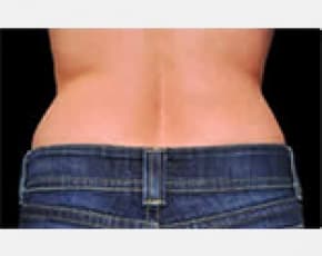 CoolSculpting Before & After Patient #2139