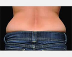 CoolSculpting Before & After Patient #2139