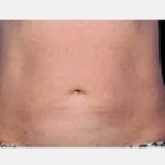 CoolSculpting Before & After Patient #2138
