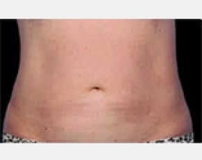 CoolSculpting Before & After Patient #2138