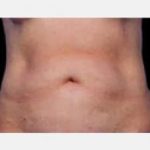 CoolSculpting Before & After Patient #2138