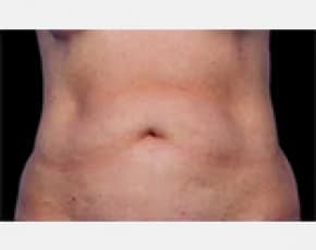 CoolSculpting Before & After Patient #2138
