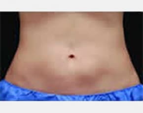 CoolSculpting Before & After Patient #2137