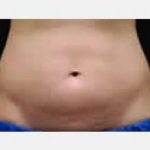 CoolSculpting Before & After Patient #2137