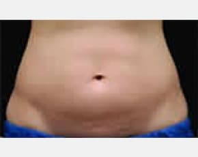 CoolSculpting Before & After Patient #2137