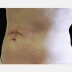 CoolSculpting Before & After Patient #2136