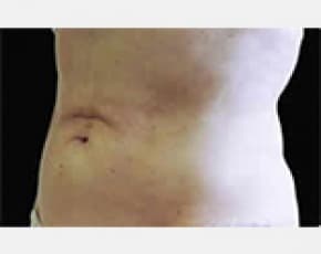 CoolSculpting Before & After Patient #2136