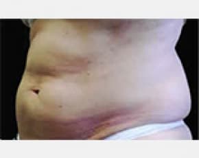 CoolSculpting Before & After Patient #2136