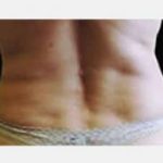 CoolSculpting Before & After Patient #2135