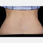 CoolSculpting Before & After Patient #2134