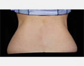 CoolSculpting Before & After Patient #2134