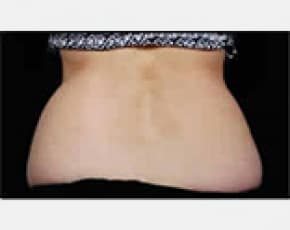 CoolSculpting Before & After Patient #2134