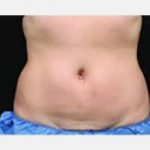CoolSculpting Before & After Patient #2133