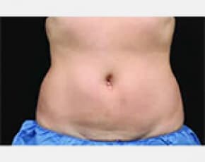 CoolSculpting Before & After Patient #2133